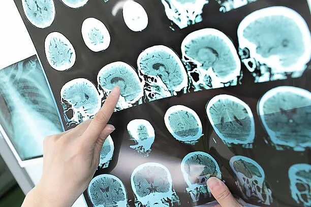Misdiagnosis Stroke